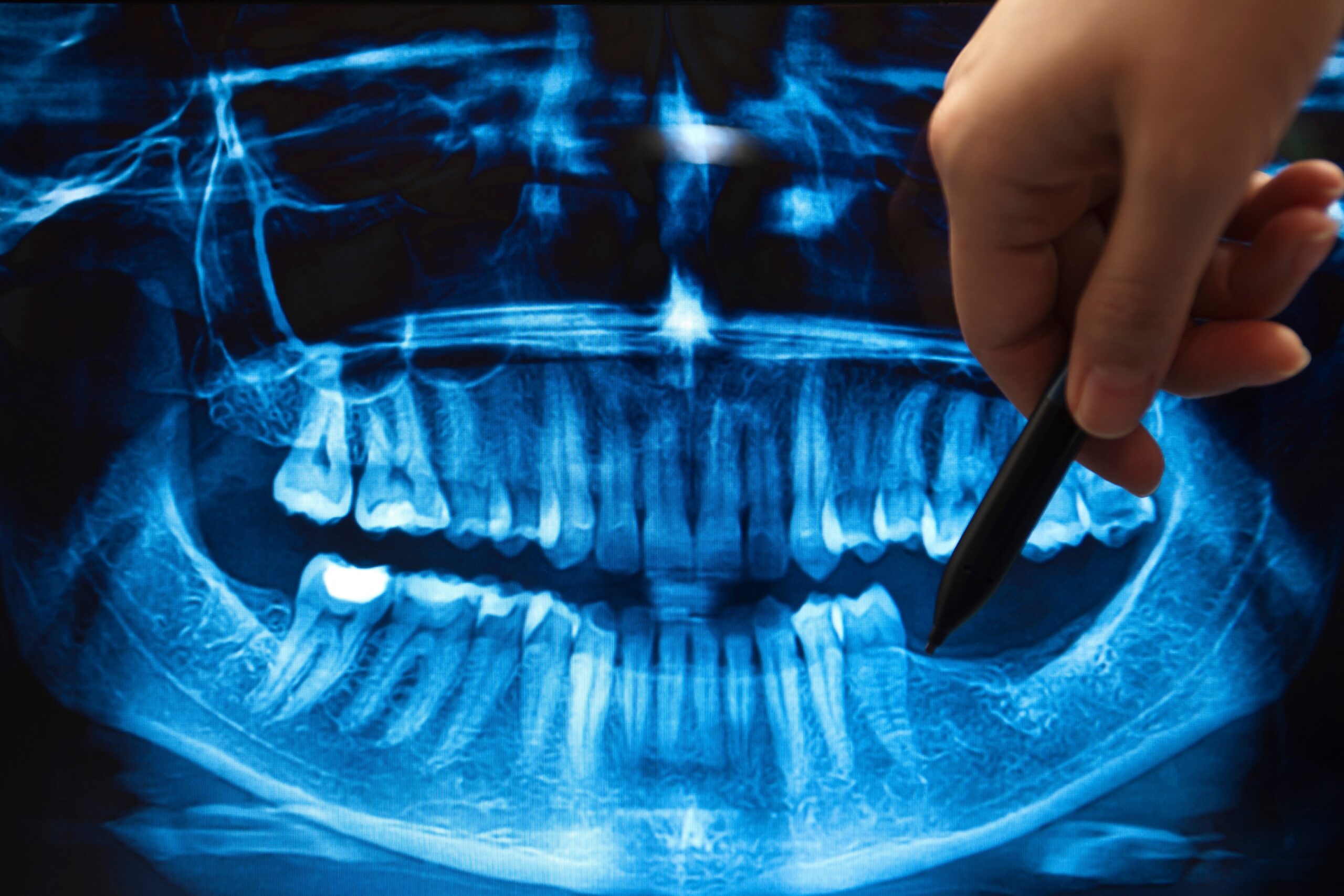 Panoramic dental X-ray reviewed on a CBCT imaging workstation